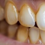 Dentists won’t tell you this: natural ways to remove tartar and whiten teeth at home